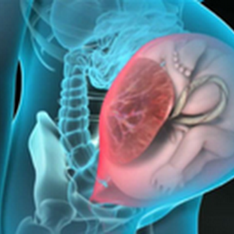 UTERINE RUPTURE,AMNIOTIC FLUID EMBOLUS Radiology Made Easy